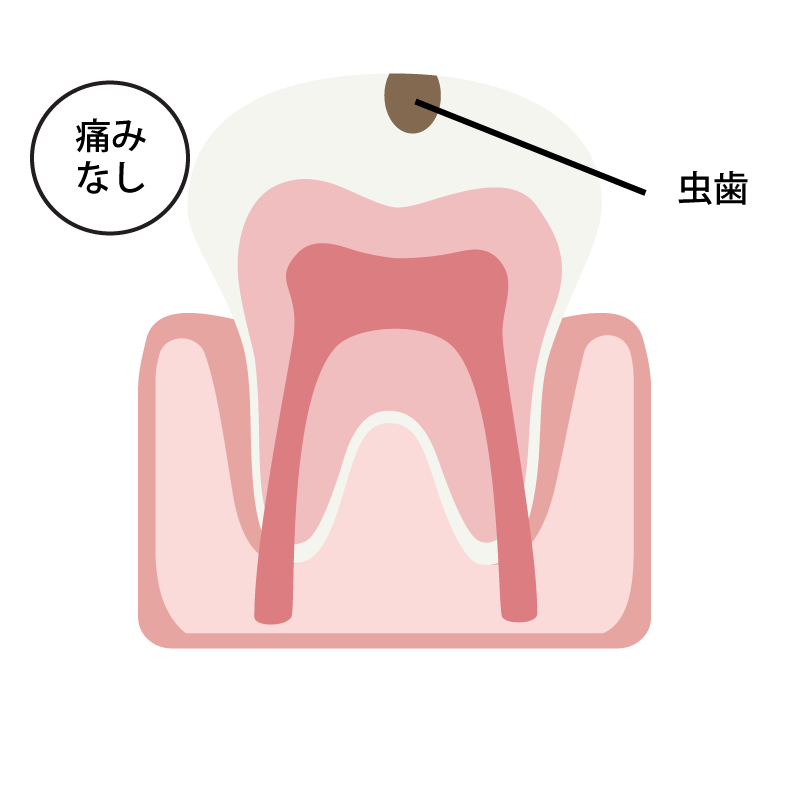 エナメル質の虫歯（C1）の場合