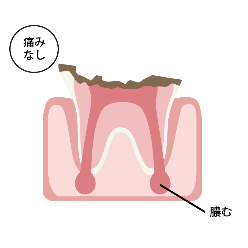 歯の根まで侵食した虫歯（C4）の場合